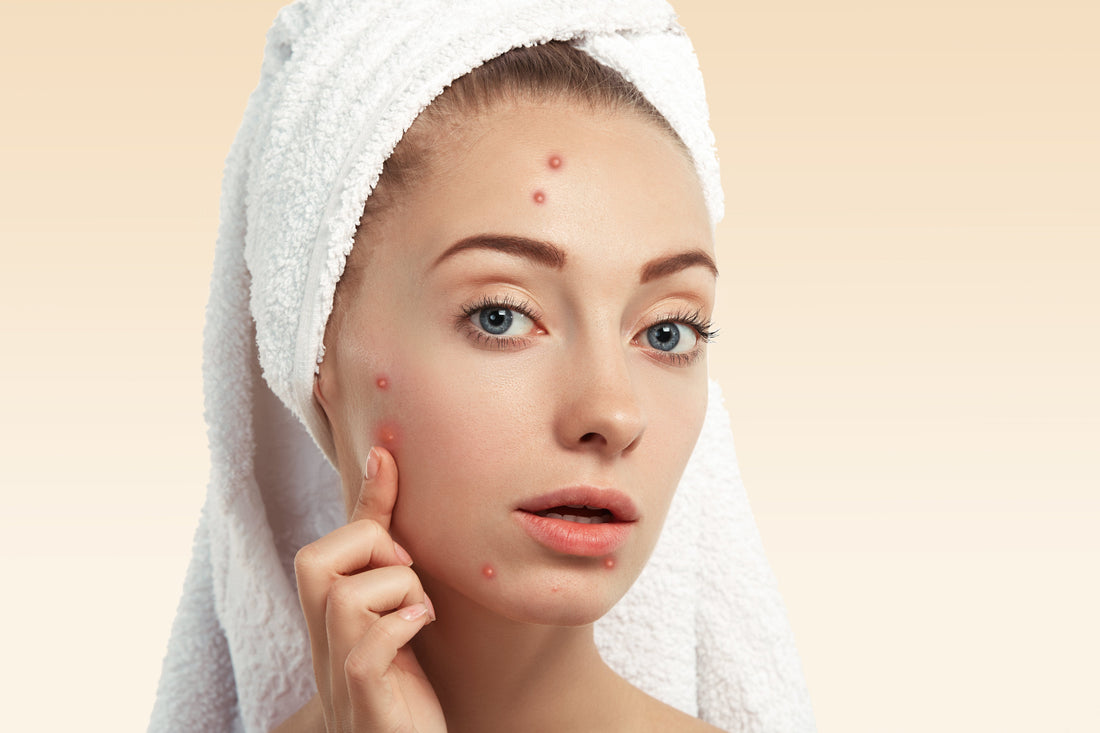how to treat hormonal acne