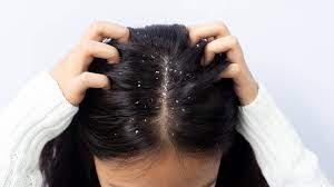 Seborrheic Dermatitis on the Scalp: Tips and Treatment